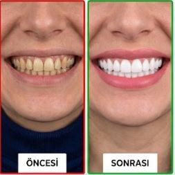 Öncesi / Sonrası 1