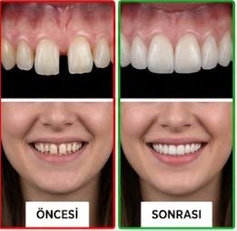 Öncesi / Sonrası 2
