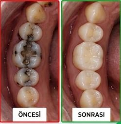 Öncesi / Sonrası 3