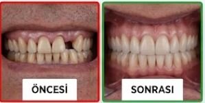 Öncesi / Sonrası 4