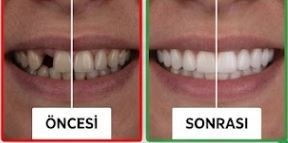 Öncesi / Sonrası 5