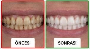 Öncesi / Sonrası 6